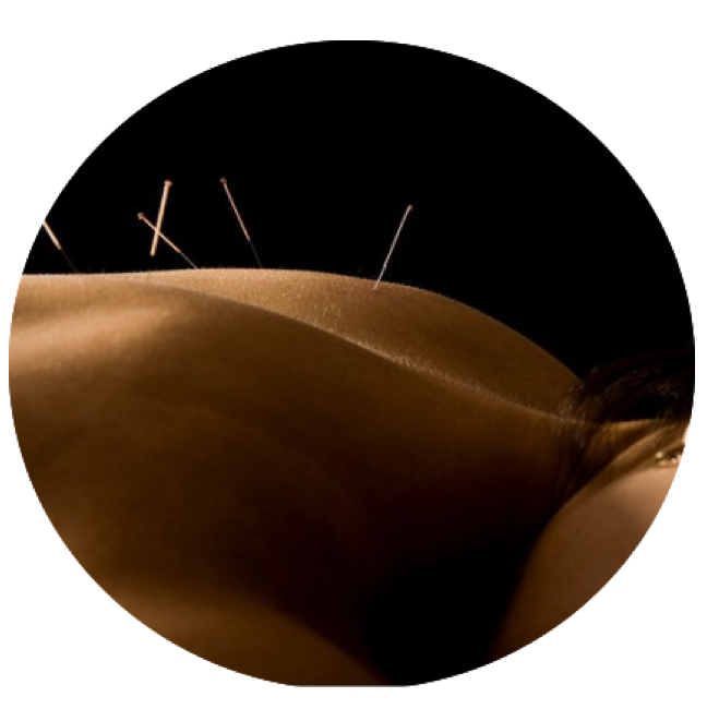 Dry Needling Physical Therapy - Portsmouth, Dover, Kittery NH 